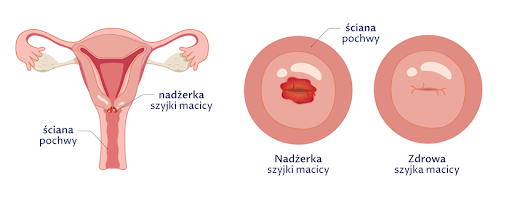 grafikia przedstawiająca jak wygląda nadżerka szyjki macicy