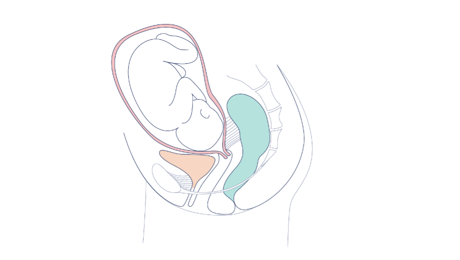 Zobacz, w jaki sposób pessar położniczy zapobiega przedwczesnemu rozwieraniu się szyjki macicy.